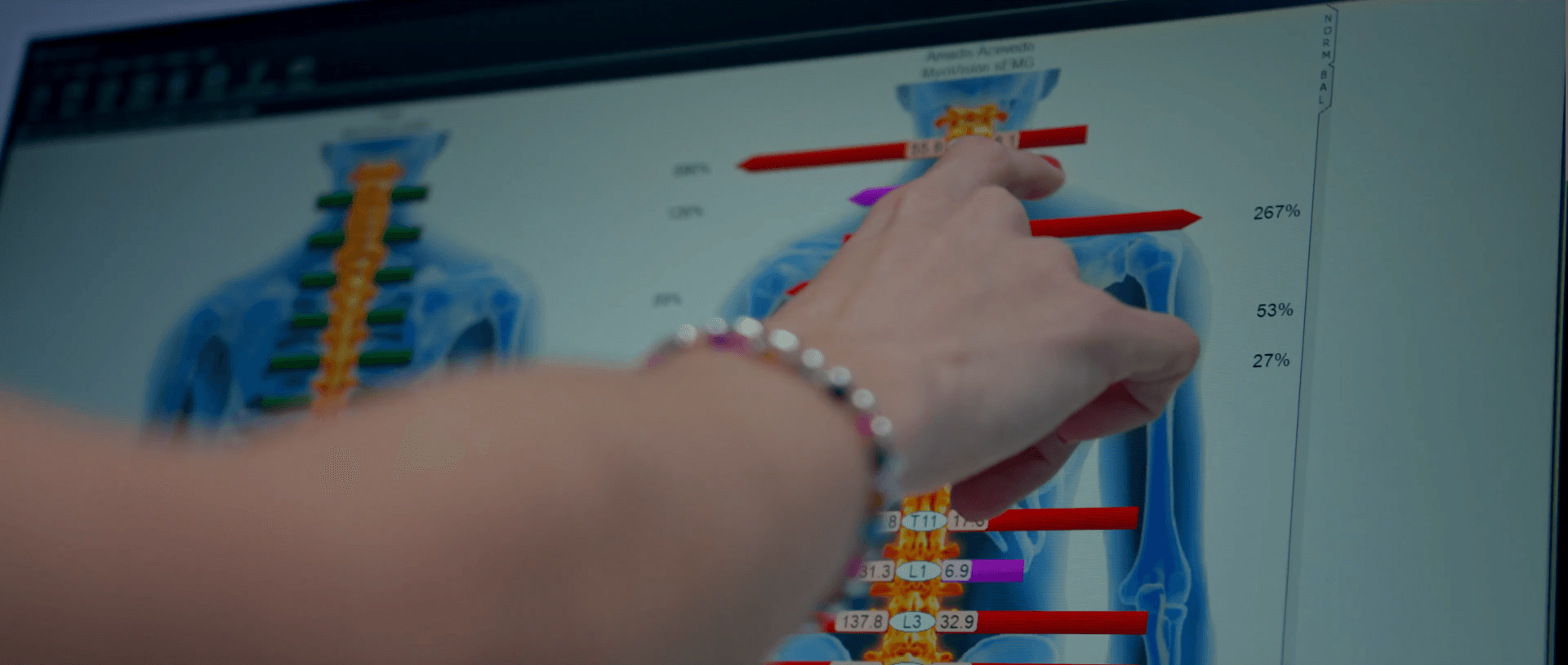MyoVision Scan (Tecnología sEMG)